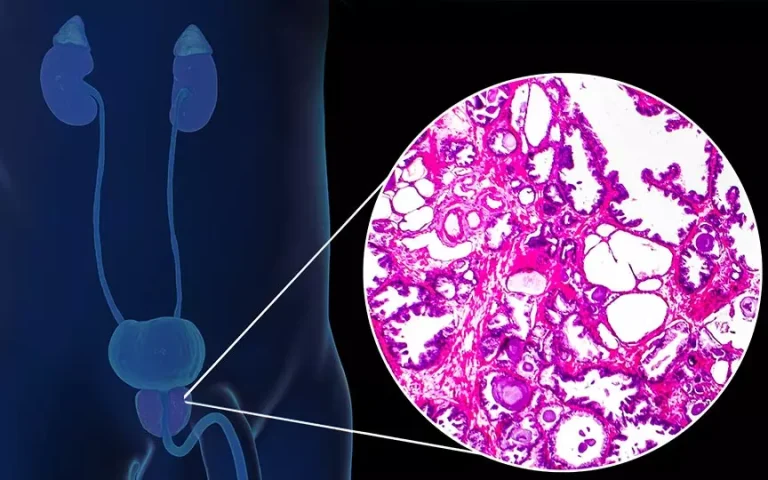 inflamação crônica da próstata